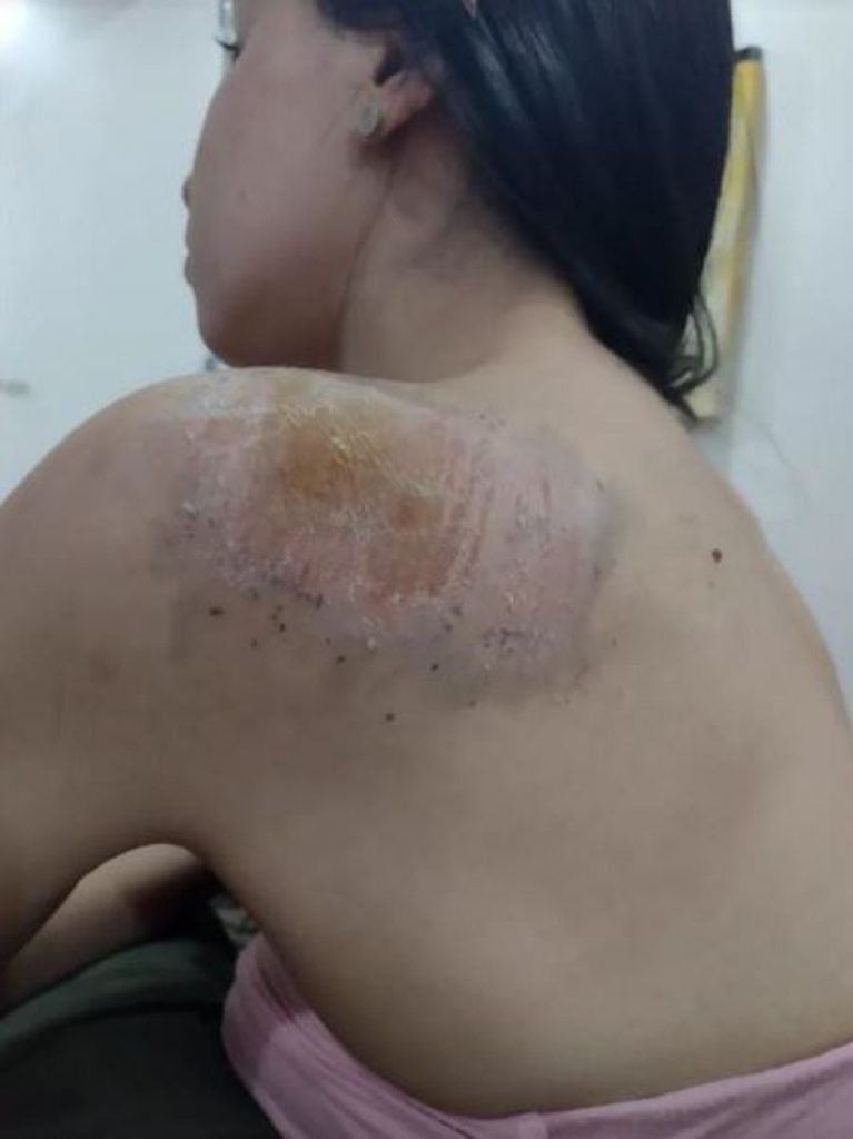 Estudante que sofreu assédio divulgou imagem dos ferimentos no seu Instagram