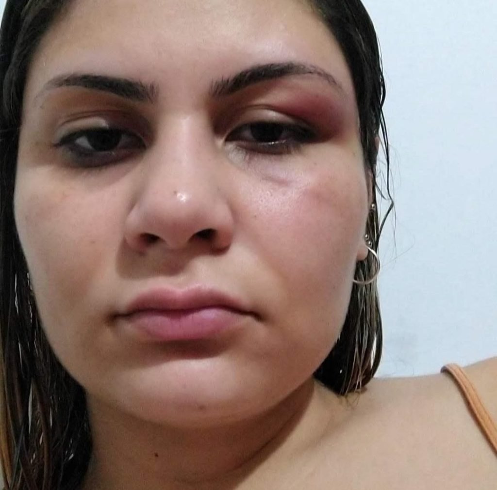 Gabriela Batista Figueiredo de Freitas da Silva mostra agressão.