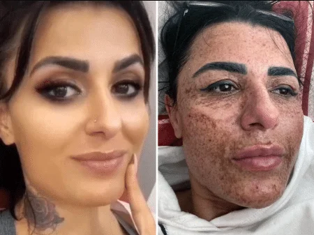 Esteticista queima o rosto de cliente após durante briga com o namorado, na Turquia