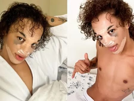 Após Pabllo Vittar postar foto com o rosto inchado nas redes sociais, fãs se assustam e questionam novo procedimento feito pela cantora.