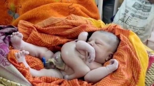 Veja o bebê que nasceu com quatro braços e quatro pernas, na Índia