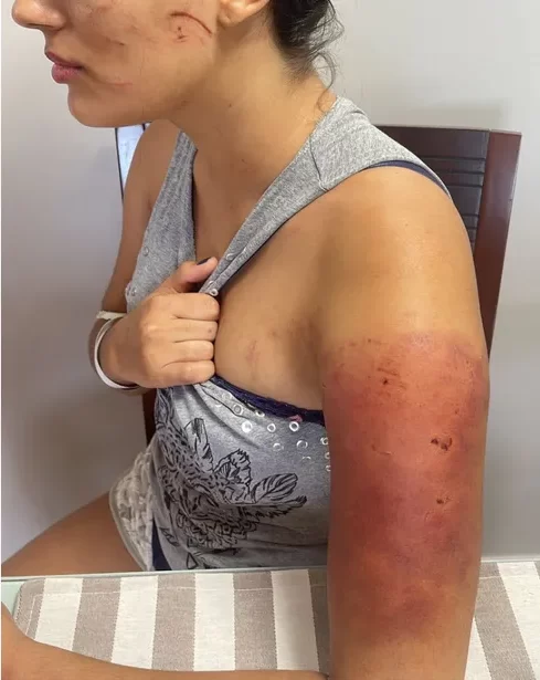 Jovem é agredida com arma após namorado se irritar com ela bebendo cerveja, em Goiânia