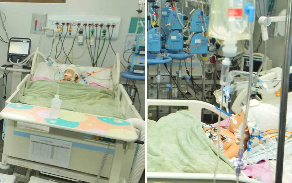 Gêmeas siamesas: Heloá tem picos febris e Valentina segue em coma