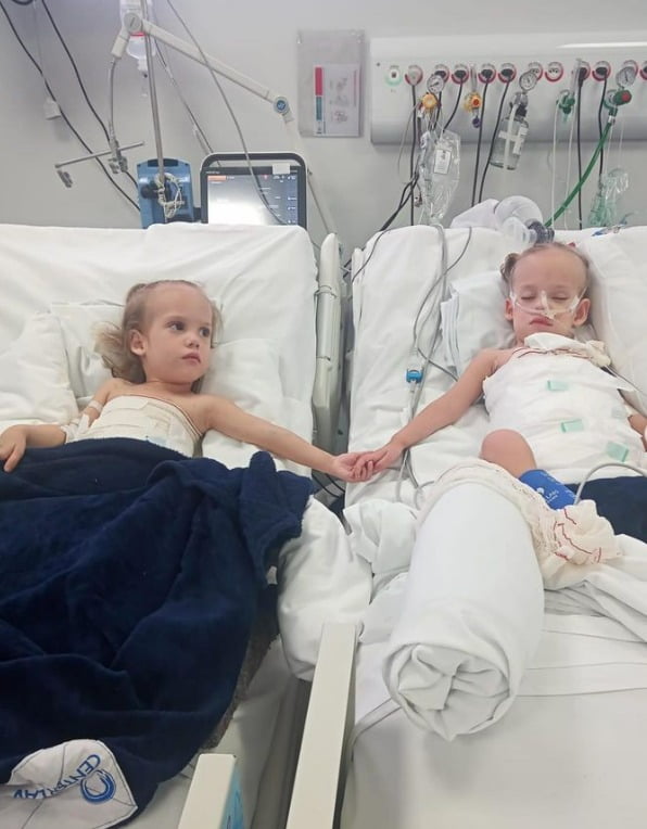 As gêmeas siamesas Heloá e Valentina realizaram uma cirurgia de separação há aproximadamente um mês