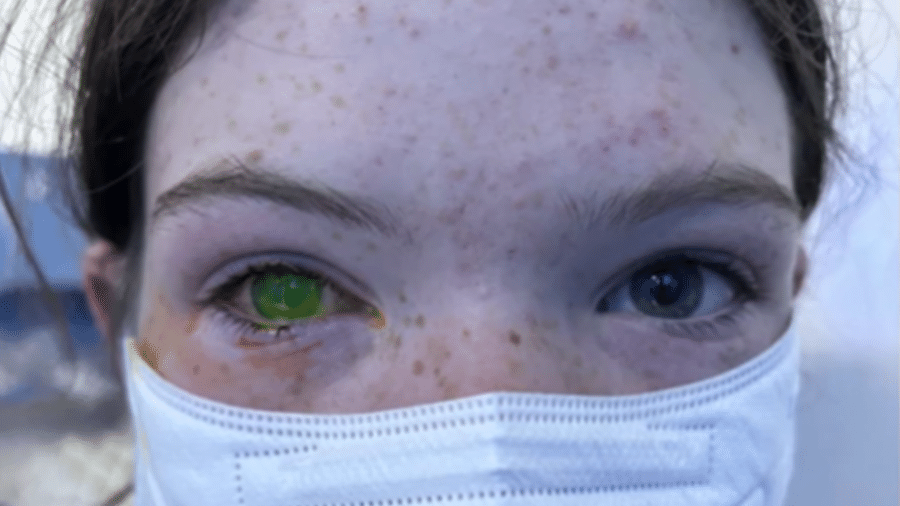 Austrália registra doença que deixa olhos verdes e provoca dor intensa