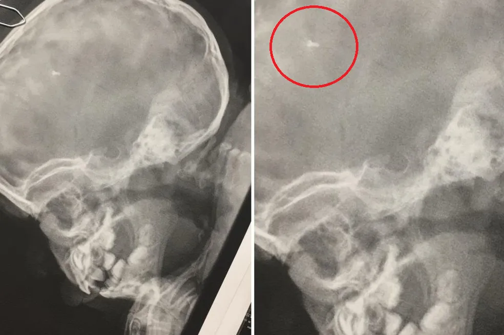 Parafuso é encontrado em crânio de criança após dois anos que foi submetida à cirurgia