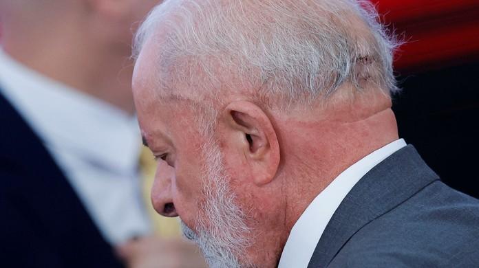 Lula da Silva Passa por Embolização para Evitar Sangramento Cerebral