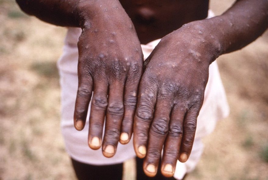 Doença é considerada leve por não estar adaptada ao corpo humano. (Foto: Reprodução)