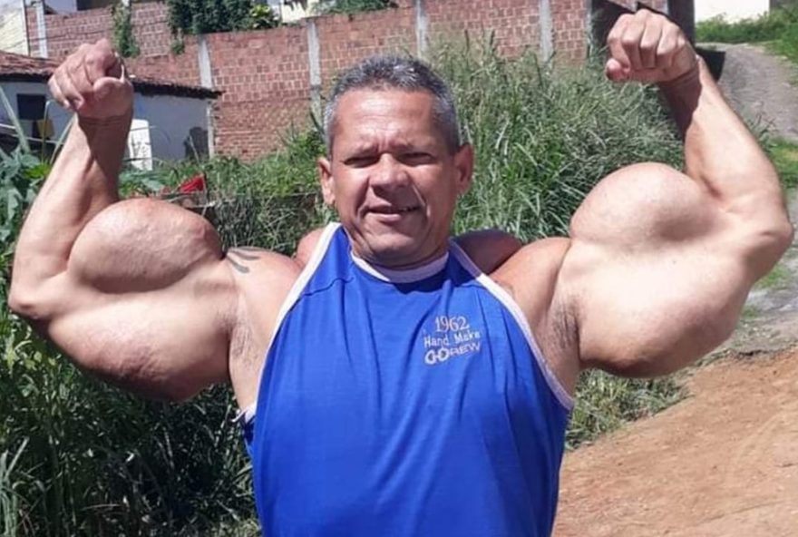 22riscos-do-uso-clandestino-de-oleo-mineral-para-tonificacao-muscular3A-alerta-de-cirurgiao-plastico22