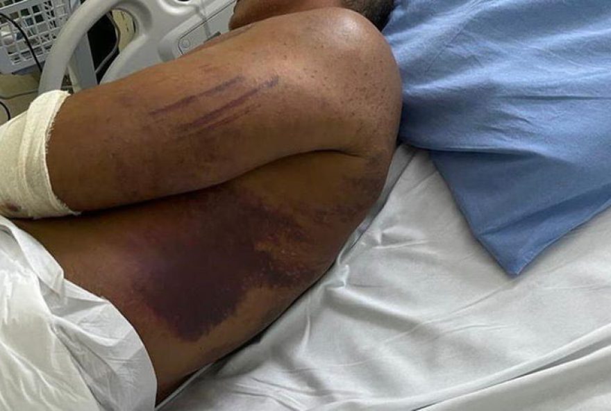 Vítima foi tortura e teve sérias lesões pelo corpo, sendo internada com suspeita de Covid-19 por um médico militar. Crime aconteceu em 2021. (Foto: Reprodução)