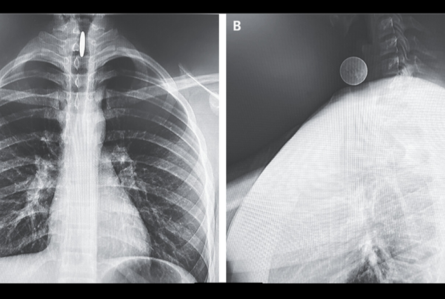 Um adolescente de 14 anos da Califórnia tinha engolido uma moeda de 0,25 centavos, que ficou presa entre as cordas vocais do garoto. 
(foto: Victor Bor-Chang Hsue e Vijay Patel/New England Journal of Medicine/Divulgação)