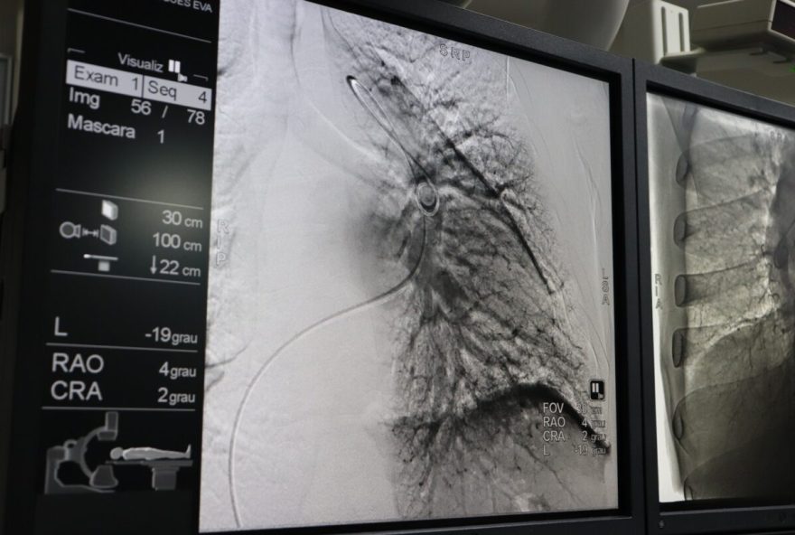 Agora realizada no HGG, angioplastia pulmonar é feita por cateterismo cardíaco, em pacientes com hipertensão pulmonar tromboembólica 
(Fotos: Idtech)