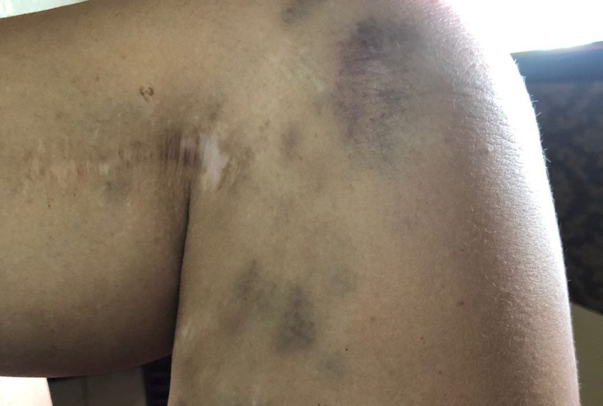 Médica tem cirurgias na perna e sofre com dores depois de agressão / Foto: Arquivo pessoal