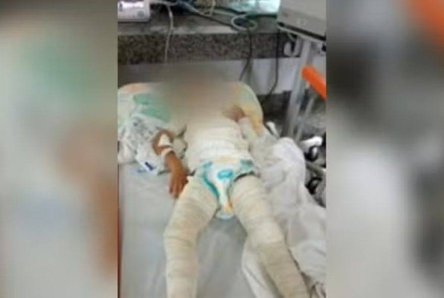 Criança é hospitalizada na UTI após sofrer queimaduras brincando na rua em Goiânia (Foto: Reprodução/TV Anhanguera)