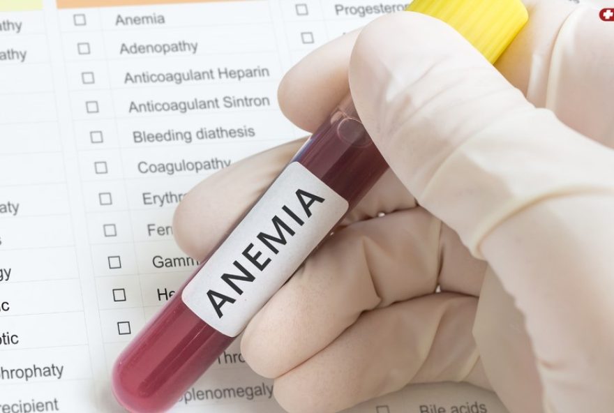 anemia-e-queda-de-cabelo3A-como-a-deficiencia-de-ferro-afeta-os-fios