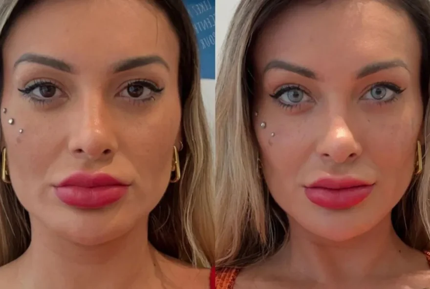 antes-e-depois-andressa-urach
