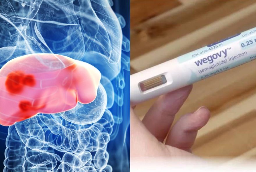 anvisa-aprova-semaglutida-para-tratatar-gordura-no-figado-com-inflamacao anvisa-aprova-semaglutida-para-tratatar-gordura-no-figado-com-inflamacao