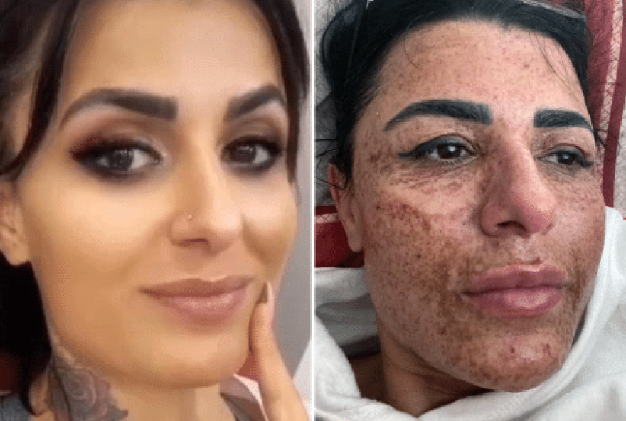 Esteticista queima o rosto de cliente após durante briga com o namorado, na Turquia