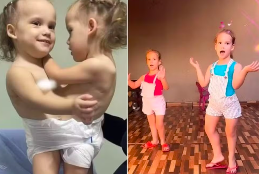 atualizacao-sobre-valentina-e-heloa2C-gemeas-separadas-em-cirurgia-historica atualizacao-sobre-valentina-e-heloa2C-gemeas-separadas-em-cirurgia-historica