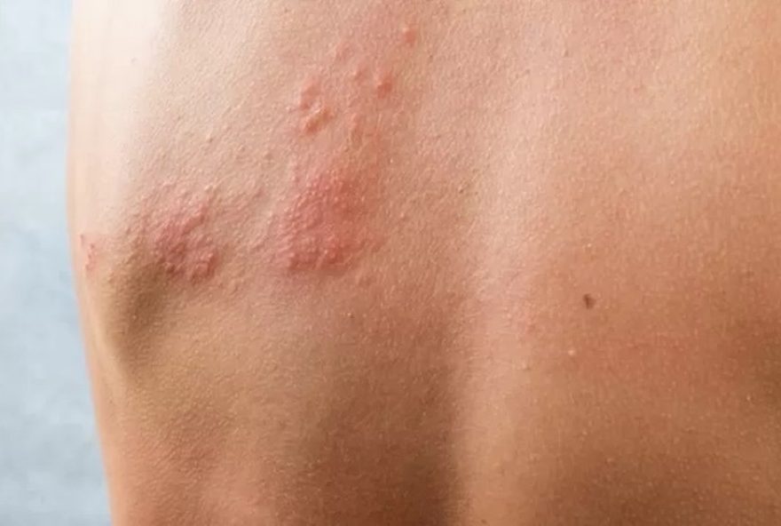 aumento-preocupante-de-casos-de-herpes-zoster-em-piracicaba3A-desafios-e-impactos-na-saude-publica aumento-preocupante-de-casos-de-herpes-zoster-em-piracicaba3A-desafios-e-impactos-na-saude-publica