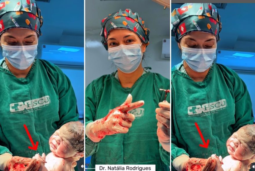 bebe-nasce-com-diu-na-mao-apos-falha-no-metodo-contraceptivo