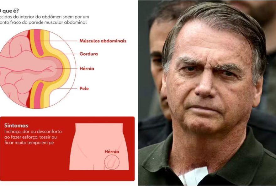 bolsonaro-passa-por-cirurgia-para-tratar-hernia-em-hospital-de-brasilia bolsonaro-passa-por-cirurgia-para-tratar-hernia-em-hospital-de-brasilia