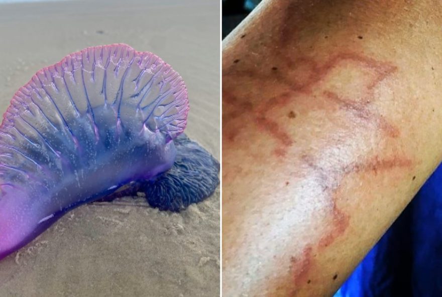 caravelas-portuguesas-causam-mais-de-500-queimaduras-em-um-dia-na-praia-do-cassino2C-rs3A-saiba-como-agir caravelas-portuguesas-causam-mais-de-500-queimaduras-em-um-dia-na-praia-do-cassino2C-rs3A-saiba-como-agir