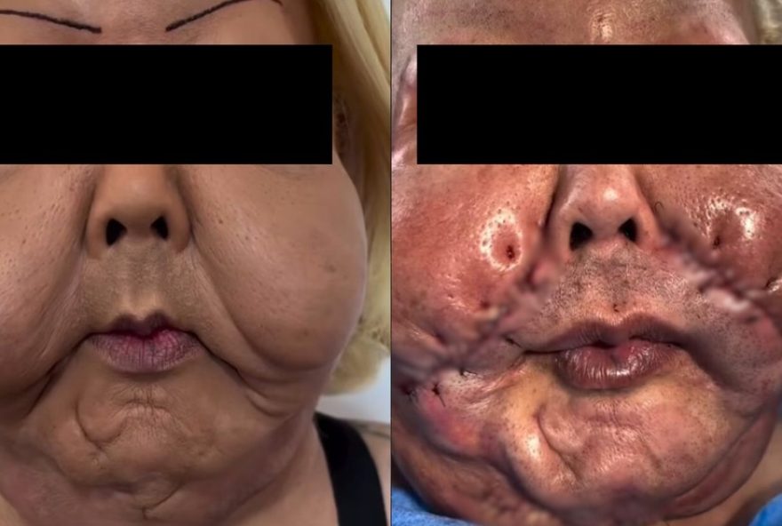 cirurgia-da-juju-do-pix-para-remocao-de-oleo-mineral3A-procedimento-realizado-com-sucesso-em-sao-paulo