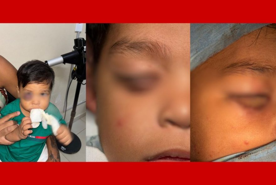 crianca-de-1-ano-passa-por-cirurgia-de-reconstrucao-da-palpebra-em-hospital-do-df3A-alivio-para-familia.-acompanhe crianca-de-1-ano-passa-por-cirurgia-de-reconstrucao-da-palpebra-em-hospital-do-df3A-alivio-para-familia.-acompanhe