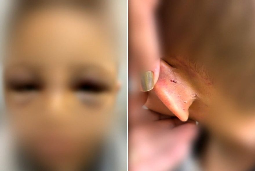 crianca-de-6-anos-e-internada-em-goiania-com-sinais-de-maus-tratos crianca-de-6-anos-e-internada-em-goiania-com-sinais-de-maus-tratos