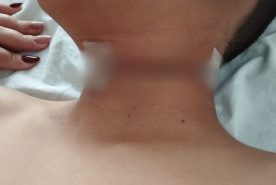 crianca-tem-pescoco-cortado-por-linha-de-pipa-em-tupa3A-acidente-grave-requer-cirurgia-emergencial
