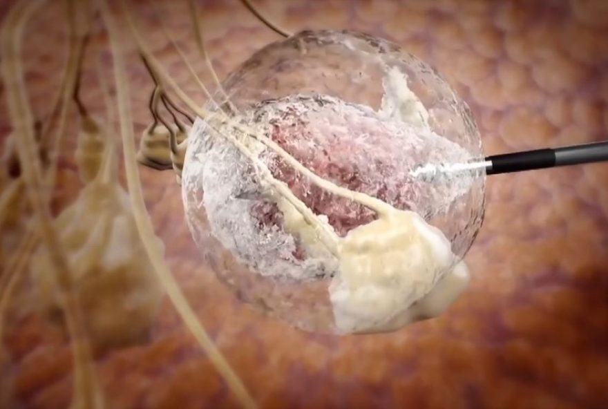 crioablacao3A-nova-tecnica-de-tratamento-para-cancer-de-mama-no-hospital-de-amor-em-sp.-entenda-o-procedimento-com-congelamento crioablacao3A-nova-tecnica-de-tratamento-para-cancer-de-mama-no-hospital-de-amor-em-sp.-entenda-o-procedimento-com-congelamento