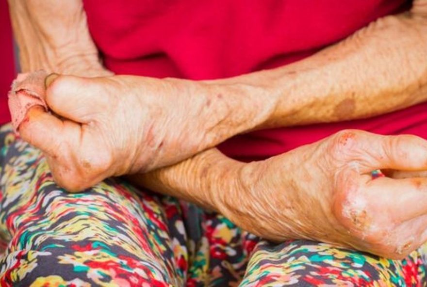 diagnostico-tardio-de-hanseniase-em-piracicaba3A-alto-grau-de-incapacidade-nos-casos diagnostico-tardio-de-hanseniase-em-piracicaba3A-alto-grau-de-incapacidade-nos-casos