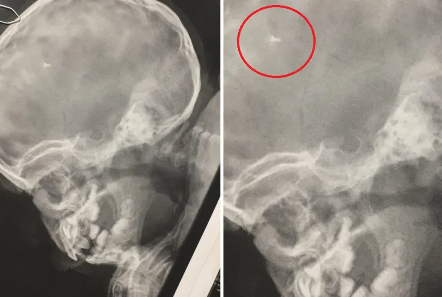 Parafuso é encontrado em crânio de criança após dois anos que foi submetida à cirurgia