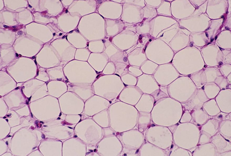 estudo-revela3A-celulas-de-gordura-marrom-podem-matar-celulas-de-cancer