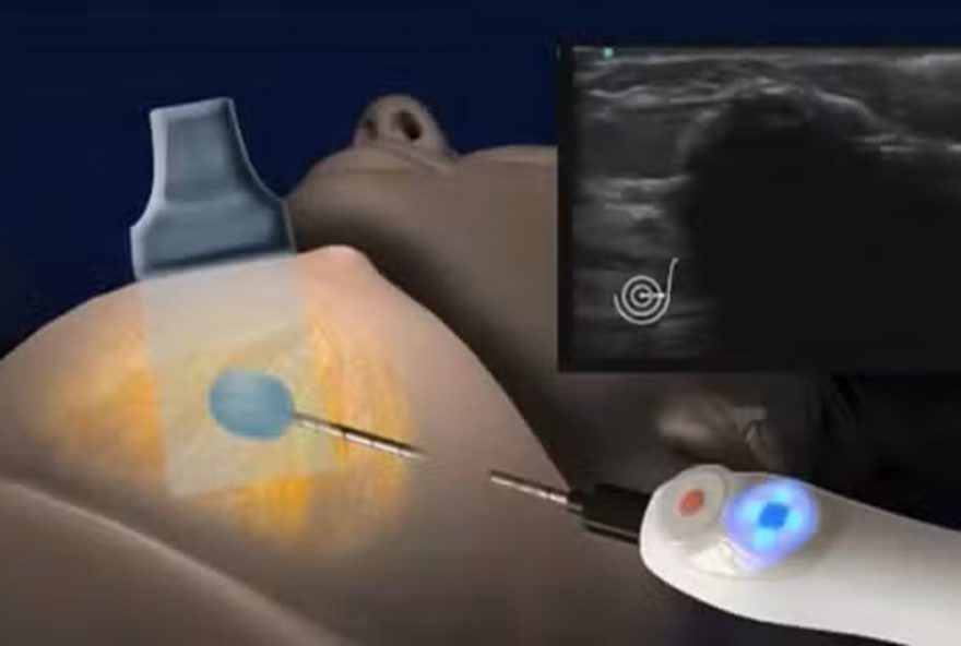 estudo-six3A-voluntarias-para-tratamento-inovador-contra-cancer-de-mama-no-hcor