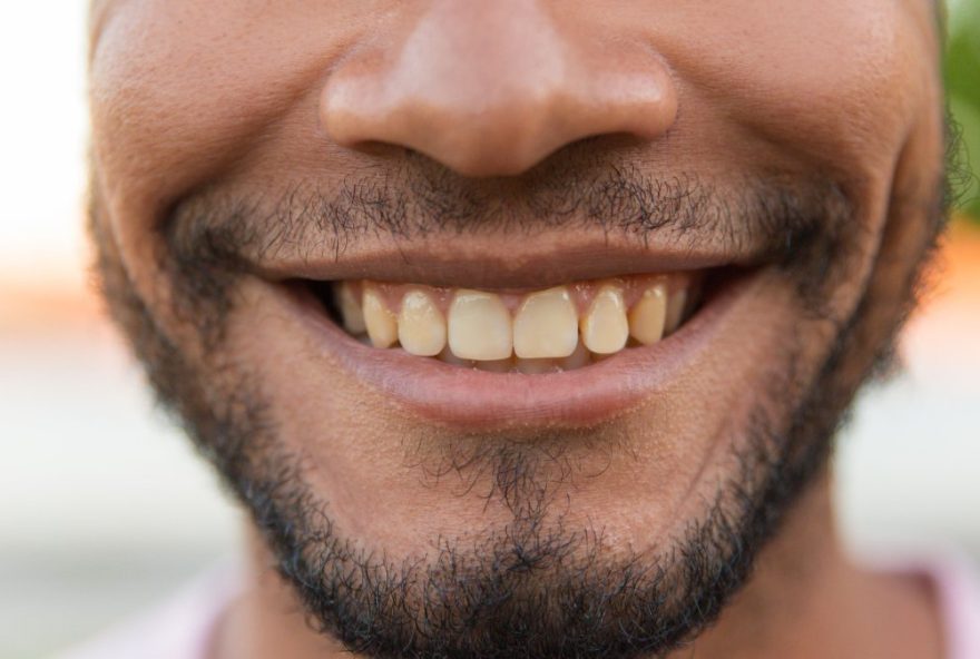 evite-o-escurecimento-dos-dentes3A-dicas-para-manter-um-sorriso-saudavel
