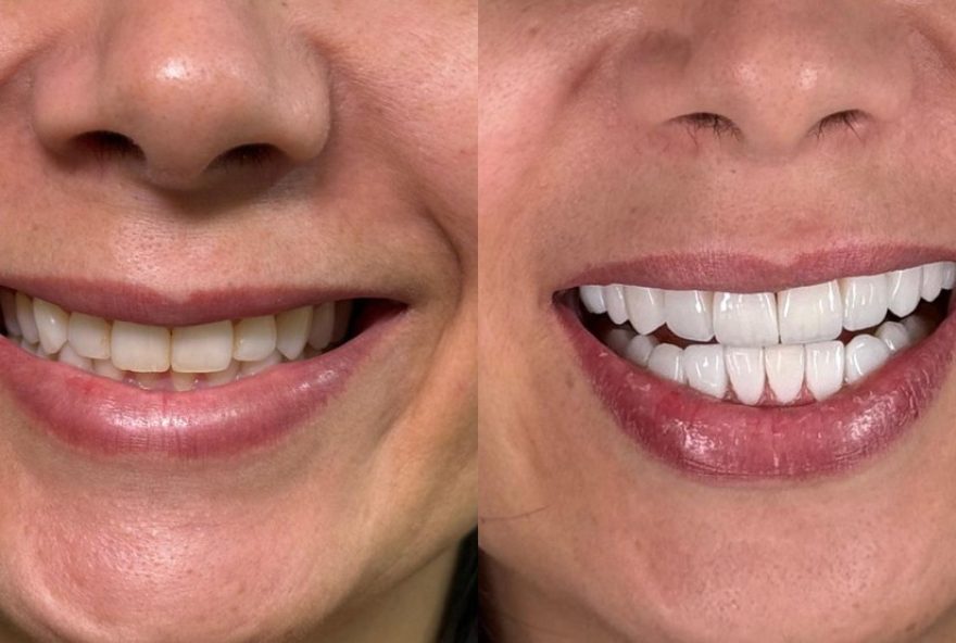 facetas-de-resina-na-mappi-odontologia3A-sorriso-natural-e-duradouro