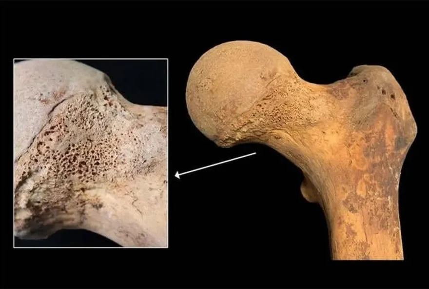 Estudo encontrou vestígios em dois corpos, que pertenciam a classe pobre da época, enterrados na gruta de um hospital em Milão. (Foto: Gaia Giordano et al)