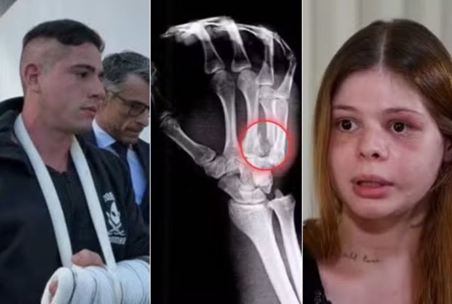fisiculturista-que-fraturou-mao-ao-espancar-namorada-medica-passa-por-cirurgia