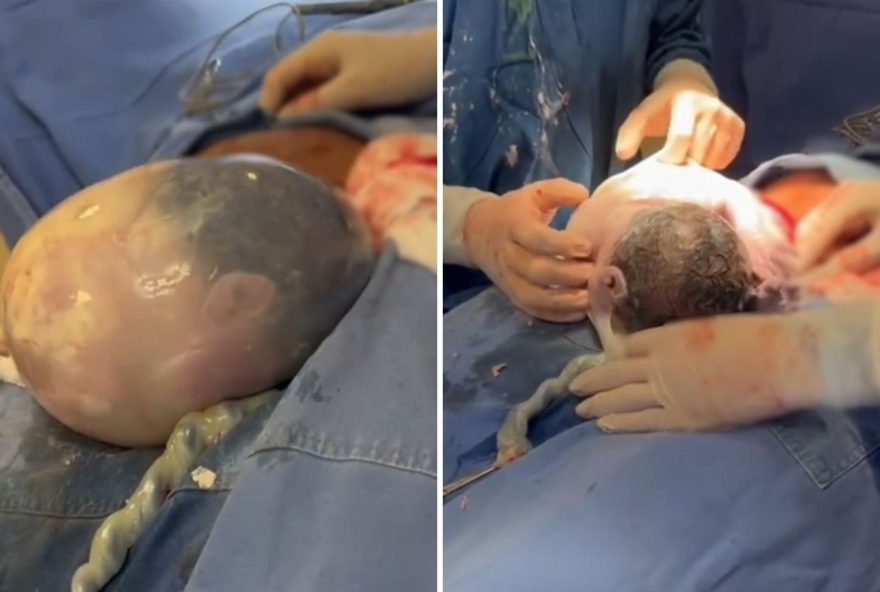 gemea-nasce-empelicada-de-forma-surpreendente-em-hospital-de-anapolis3A-assista-ao-video