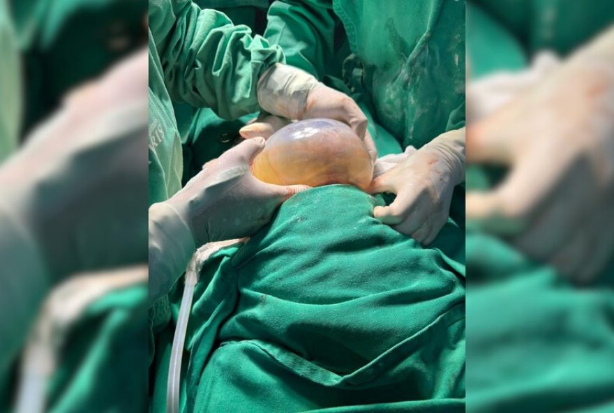 gemeo-nasce-empelicado-na-maternidade-dona-iris-e-emociona3A-momento-raro-e-especial