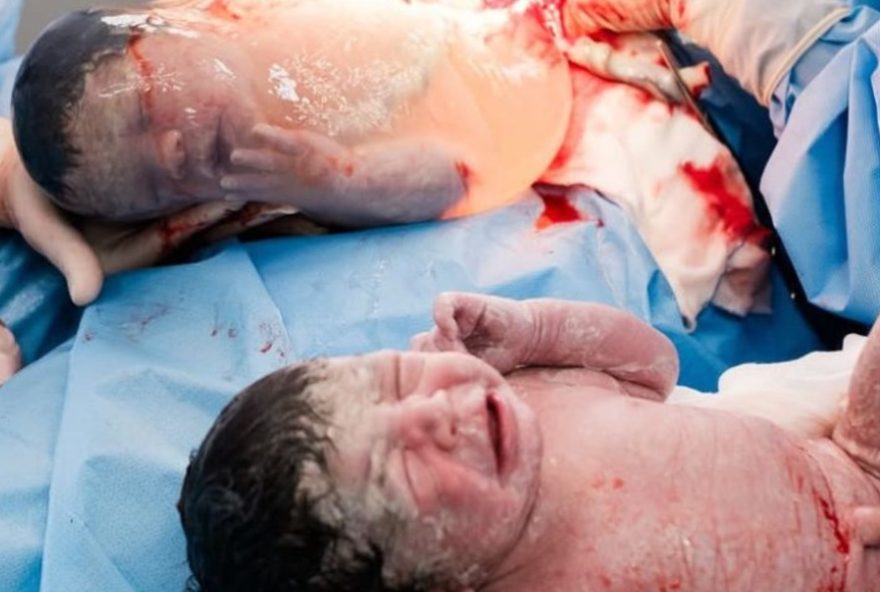 gemeos-nascem-empelicados-na-bahia3A-um-fenomeno-raro-da-obstetricia