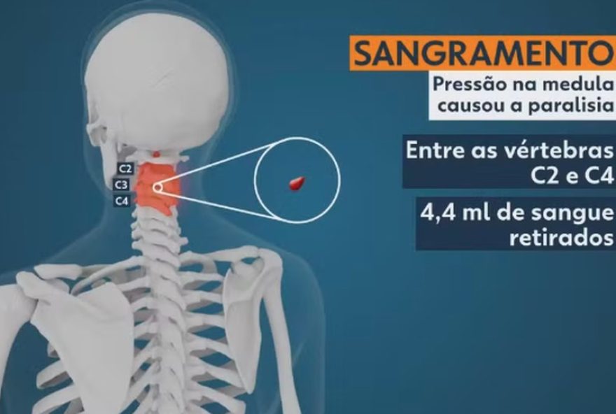 hematoma-epidural-cervical-espontaneo3A-jovem-perde-movimentos-apos-dor-na-nuca-no-pr