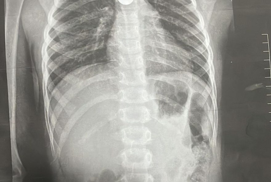 hospital-rocha-faria-alerta-pais-sobre-aumento-de-casos-de-ingestao-de-objetos-por-criancas-durante-o-verao