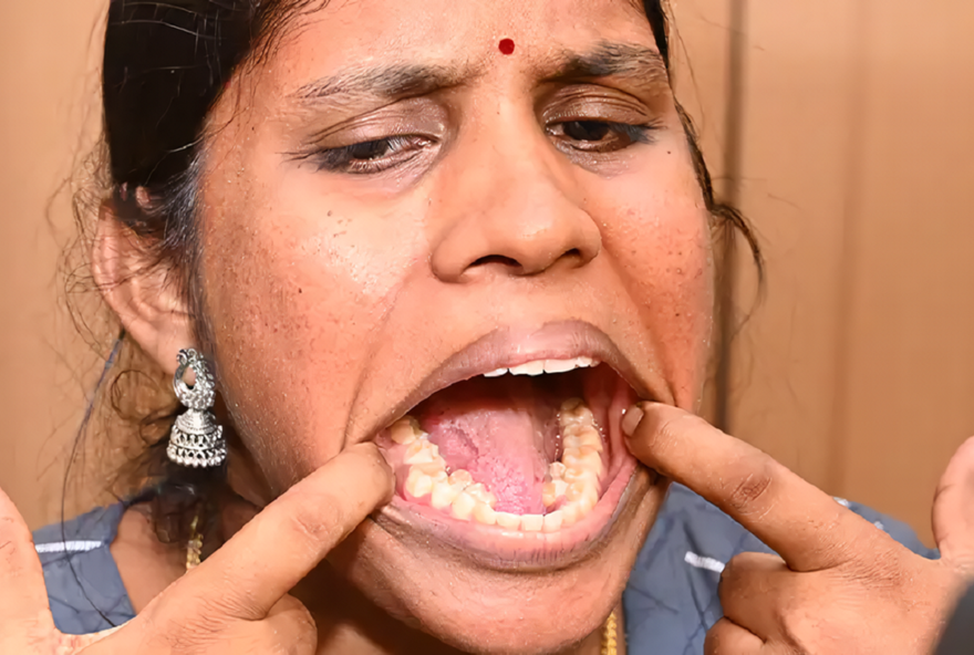 Kalpana exibe seus dentes inferiores extras Foto: Guinness World Records/Reprodução)