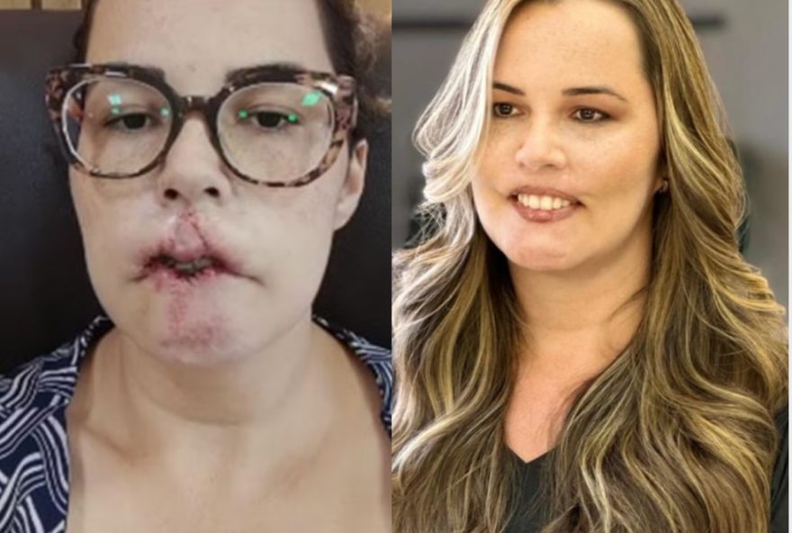 influencer-revela-rosto-apos-reconstrucao-labial-por-pmma3A-ja-comprei-um-batom-vermelho