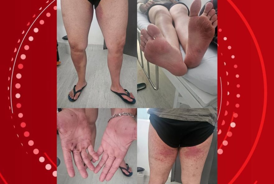 jovem-desaparecido-no-pico-parana3A-irma-divulga-imagens-das-lesoes-7C-recuperacao-em-casa-apos-alta-hospitalar jovem-desaparecido-no-pico-parana3A-irma-divulga-imagens-das-lesoes-7C-recuperacao-em-casa-apos-alta-hospitalar