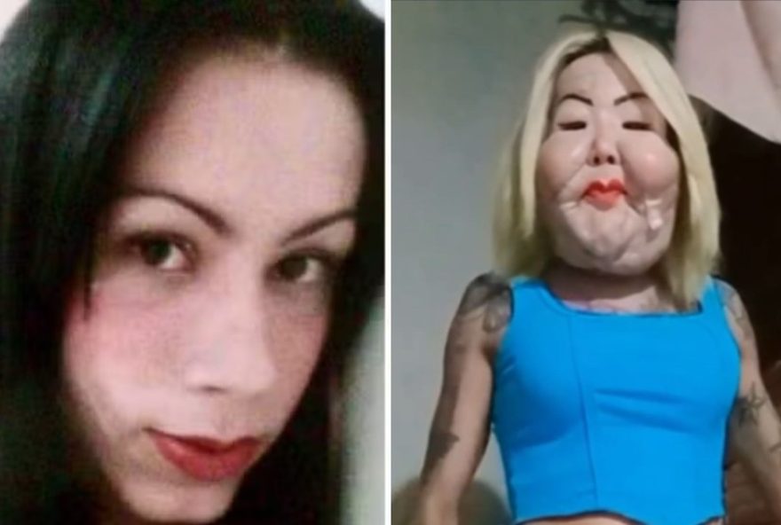 juju-do-pix-mostra-reacao-apos-50-dias-de-cirurgia-para-retirar-oleo-mineral3B-veja-antes-e-depois