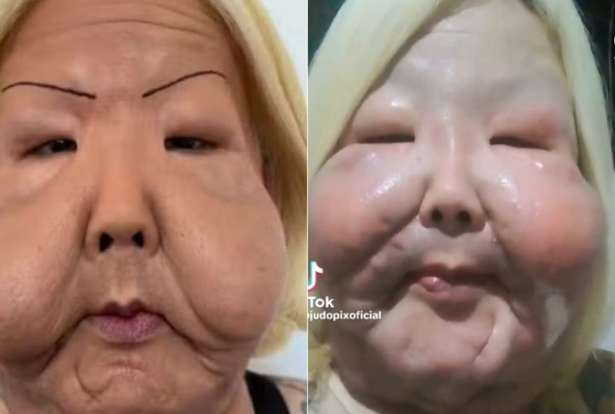 juju-do-pix-relata-complicacoes-apos-cirurgia-para-retirada-de-oleo-mineral3A-ponto-acabou-abrindo-alerta-sobre-riscos-esteticos
